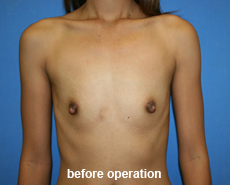 plastic-surgery-breast-augmentation